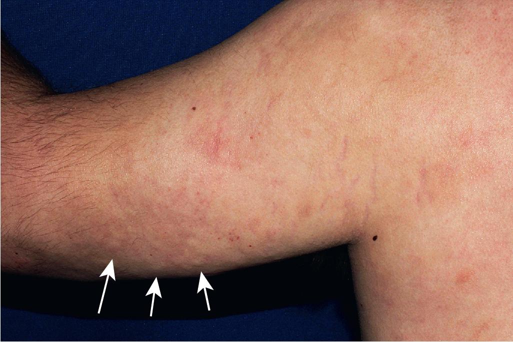 Fig. 22.15, Papulonodular dermal mucinosis in systemic lupus erythematosus (SLE). This teenager with long-term SLE in good control developed firm pruritic induration of the upper back and proximal arms with some palpable nodularity (indicated by arrows ). Deposition of mucin, resembling that of scleredema, was noted in biopsy sections.