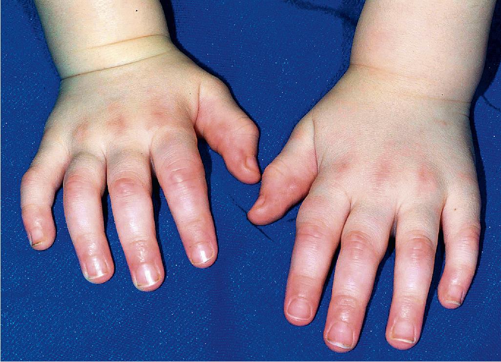 Fig. 22.16, Self-healing juvenile cutaneous mucinosis. The young girl developed numerous skin-colored to erythematous nodules and swelling on the fingers and also on the periorbital areas and trunk. She was otherwise well, and the lesions cleared during the subsequent years without intervention.