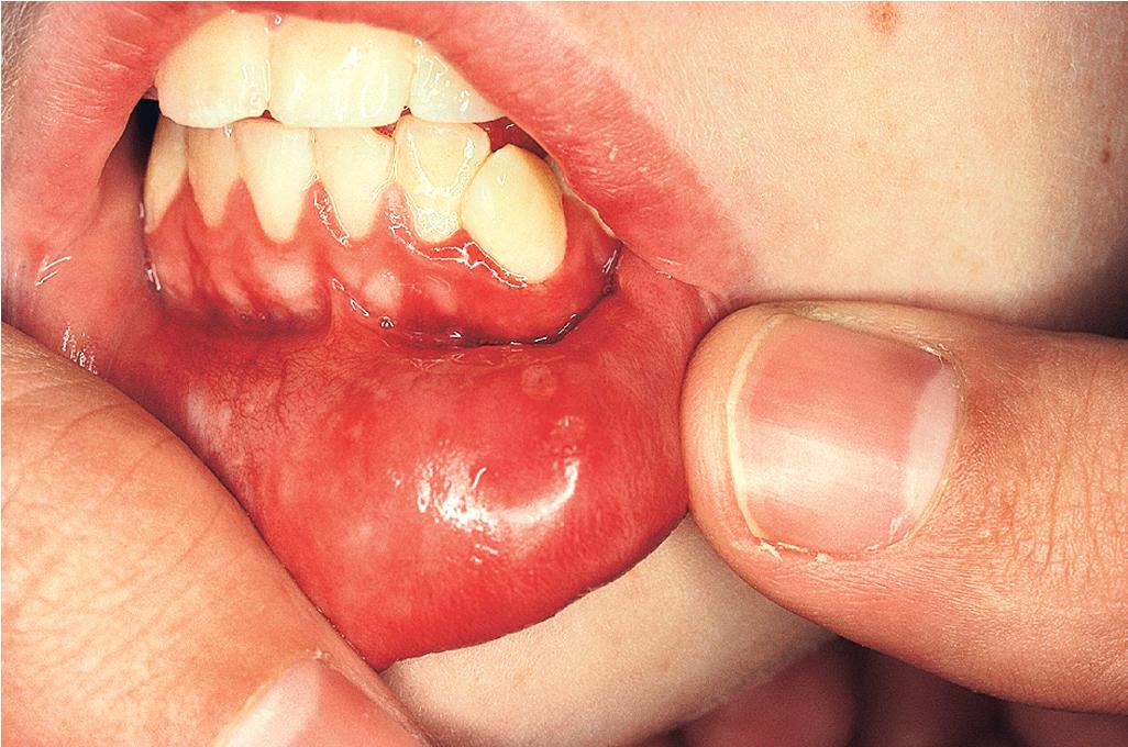 Fig. 22.17, Systemic lupus erythematosus. The gingival and buccal mucosae are red, edematous, and eroded, with subtle whitening. Note the roughness and erythema of the lips with the subtle whitening of the vermilion border.