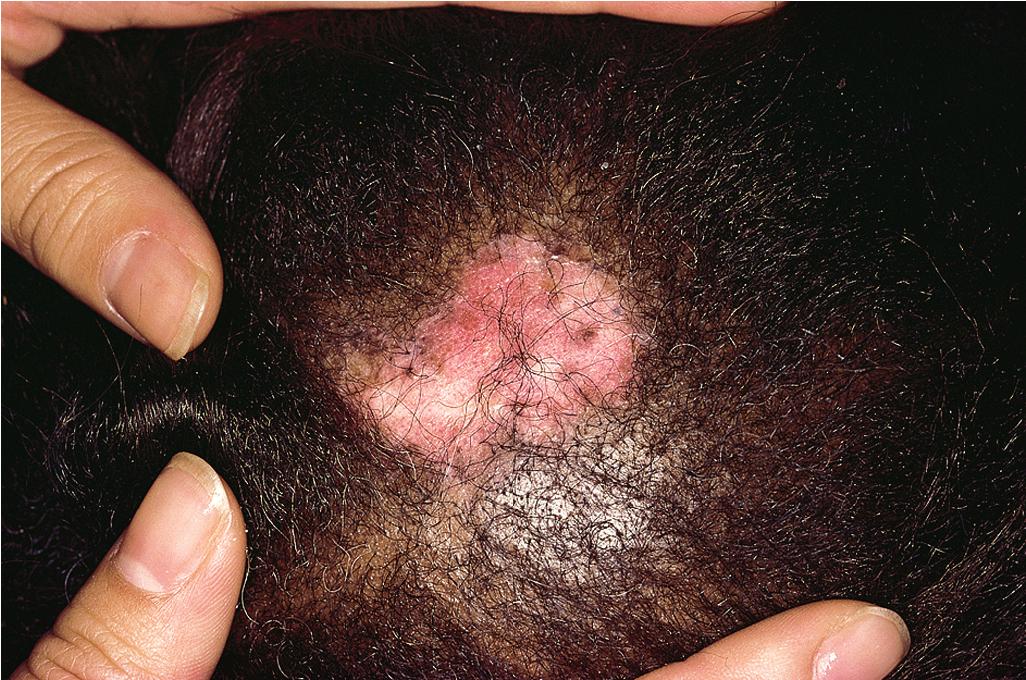 Fig. 22.18, Systemic lupus erythematosus (SLE). Discoid plaque associated with scarring alopecia of the scalp in a patient with SLE.