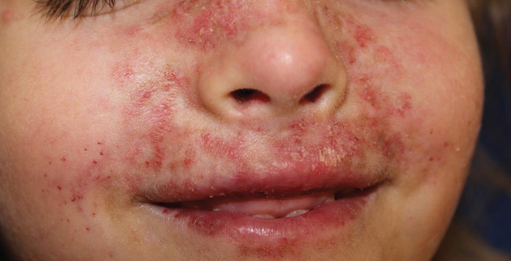 Fig. 22.19, C1q deficiency. During infancy, this girl started to develop scaling atrophic telangiectatic lesions on the face. Note the relative sparing of the perinasal area. Although not shown, the eyelids had severe telangiectasia.