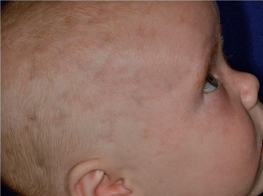 Fig. 22.22, Neonatal lupus erythematosus. Purplish erythema with focal atrophy in a reticular pattern on the face and scalp.