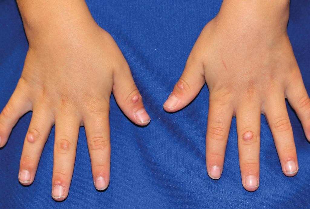 Fig. 22.2, Fibroblastic rheumatism. Firm skin-colored papules and nodules on the fingers of this young boy with juvenile idiopathic arthritis. With methotrexate, the lesions slowly cleared by early adolescence.