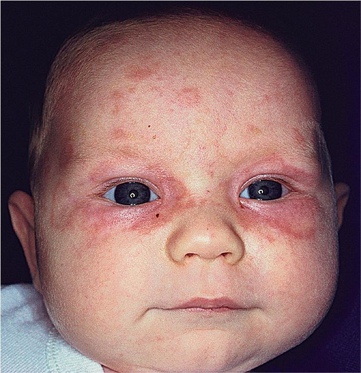 Fig. 22.20, Neonatal lupus erythematosus. Raccoon eyes and annular forehead plaques.