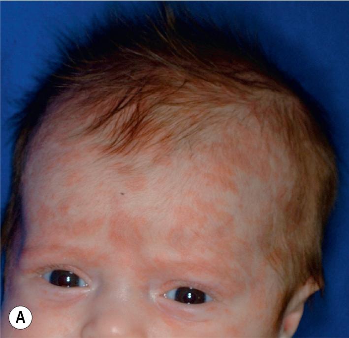 Fig. 22.23, Neonatal lupus erythematosus. (A, B) Annular plaques without detectable scale on the face, scalp, trunk, and extremities.