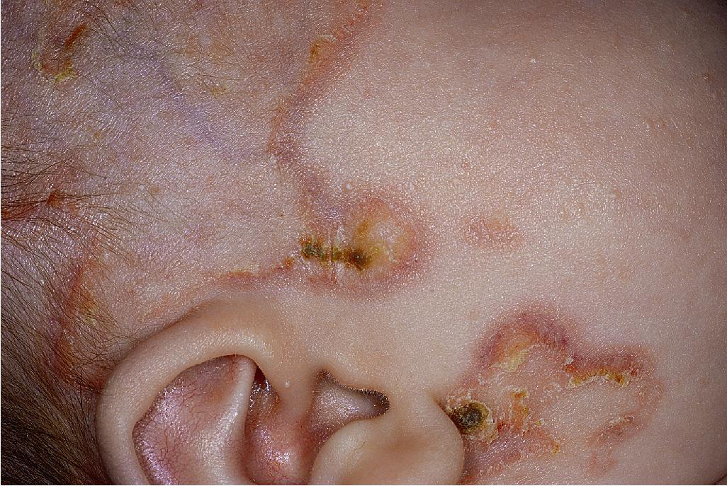 Fig. 22.21, Neonatal lupus erythematosus. Annular scaling plaques on the cheeks of this 6-week-old boy.