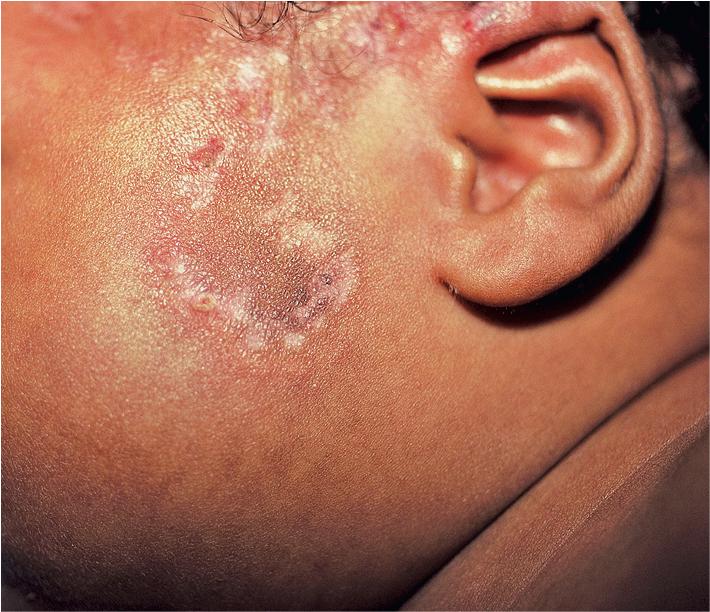 Fig. 22.24, Neonatal lupus erythematosus. Discoid lesions with atrophy and dyspigmentation on the face of a 2-month-old infant. His mother first showed signs of systemic lupus erythematosus 1 year after this baby was born.