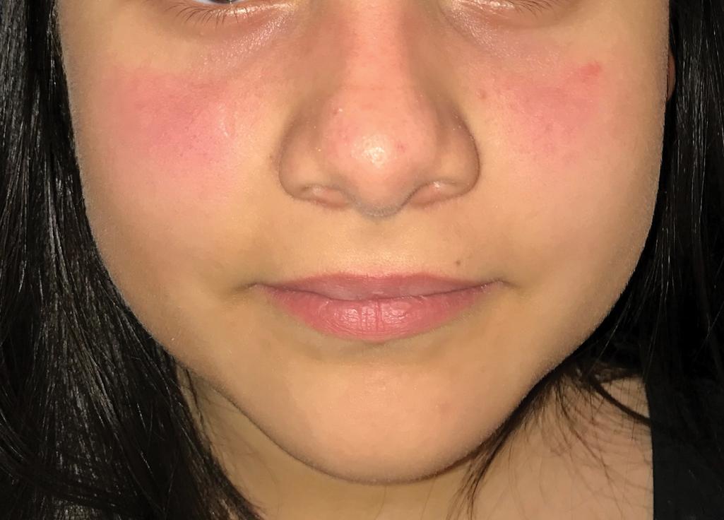 Fig. 22.3, Systemic lupus erythematosus (SLE). Distribution of the malar rash. This teenager with SLE had sun exposure and flared.