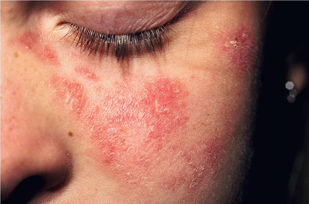 Fig. 22.4, Systemic lupus erythematosus. Mild scaling and erythema of the malar rash.