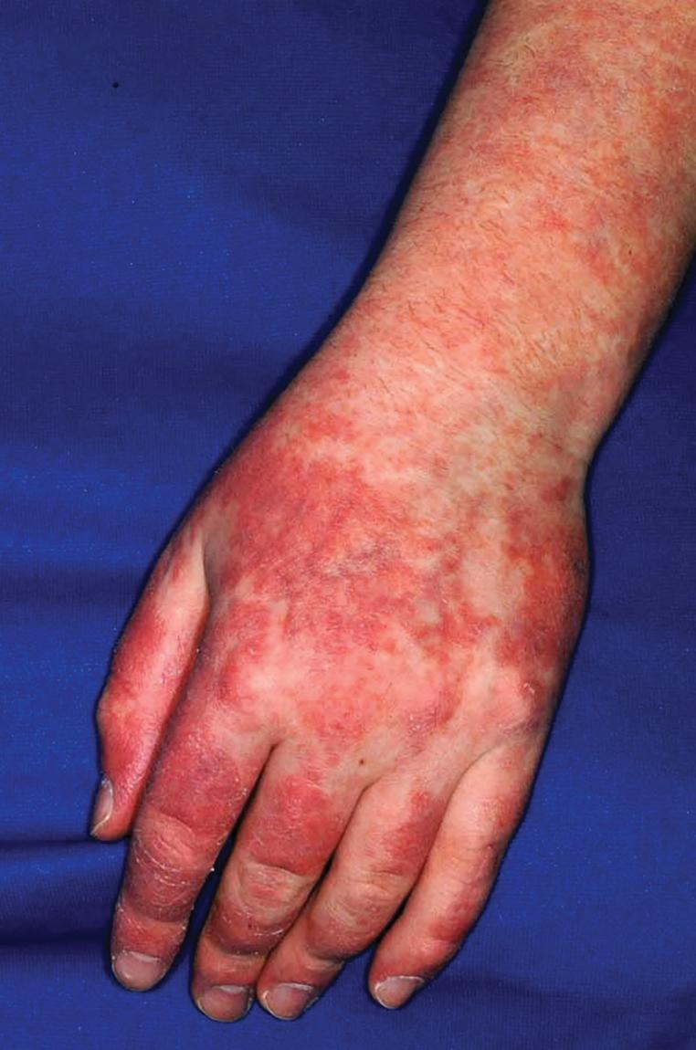 Fig. 22.5, Systemic lupus erythematosus. Bright erythema and scaling with relative sparing of skin overlying the joints, in contrast to the distribution of Gottron lesions in juvenile dermatomyositis. The periungual areas are involved.