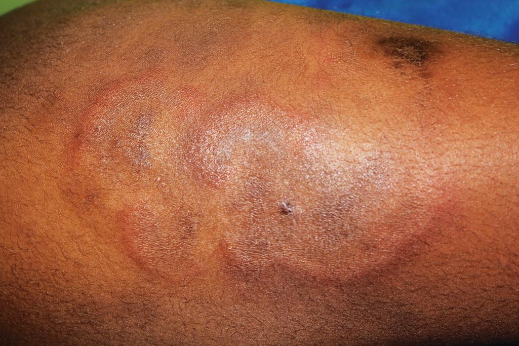 Fig. 22.6, Subacute cutaneous lupus erythematosus. The annular and polycyclic erythematous scaling lesions arose suddenly on this adolescent after sun exposure.