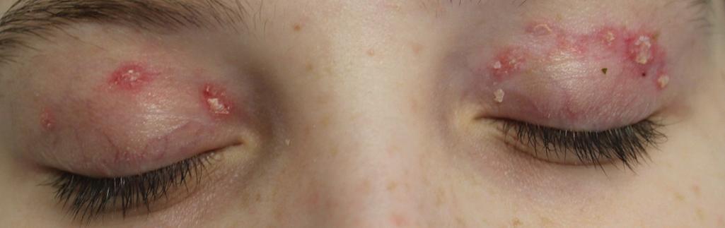 Fig. 22.7, Discoid lupus erythematosus. This teenager had erythematous scaling papules on the eyelids and eyelid margin telangiectasia.