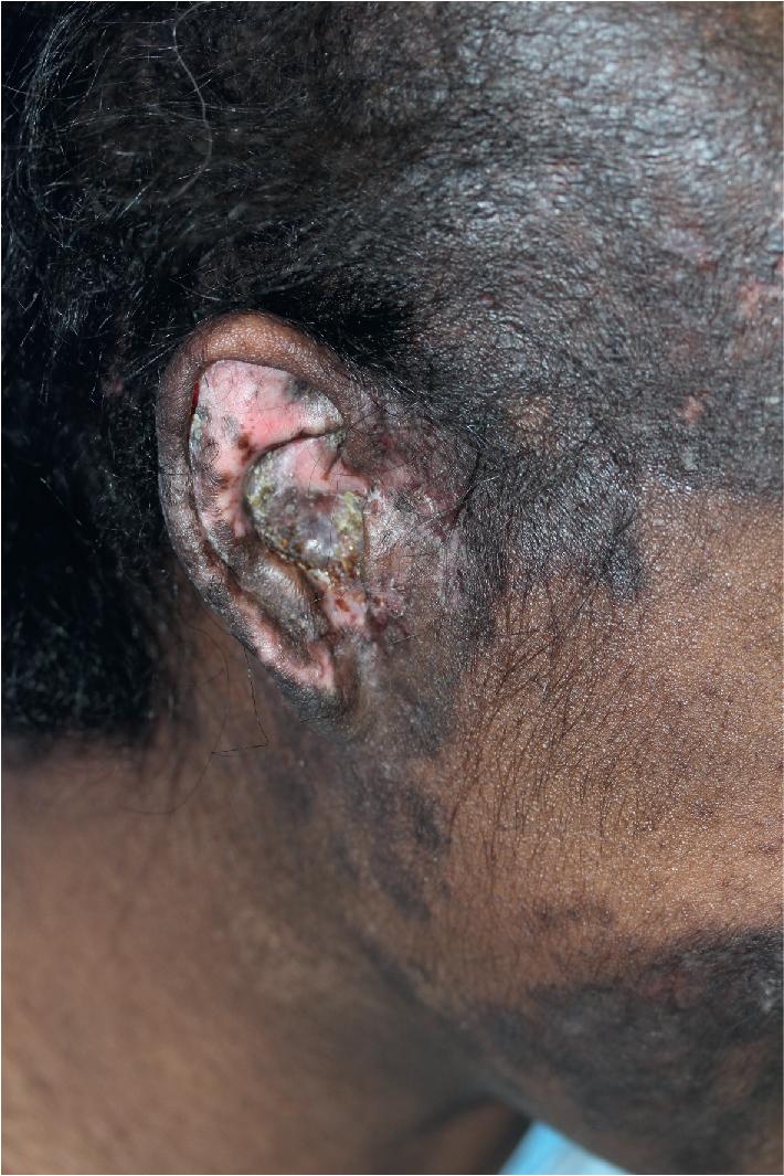 Fig. 22.8, Discoid lupus erythematosus (DLE). The ear is often involved with DLE. Note the well-defined plaques of purplish erythema, focal overlying scaling, and postinflammatory hyperpigmentation and depigmentation.