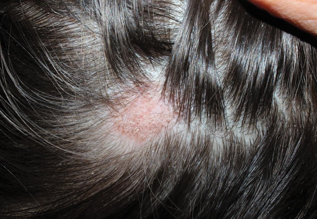 Fig. 22.9, Discoid lupus erythematosus (DLE). Alopecic plaque. Chronicity can lead to scarring alopecia.