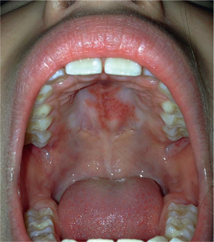 Fig. 22.10, Discoid lupus erythematosus. Dyspigmentation and atrophy of the hard palate.