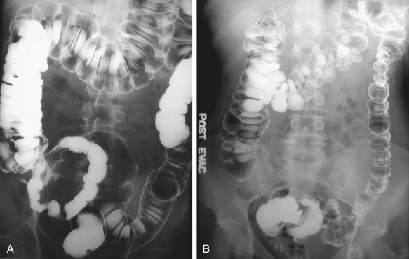 Figure 29-2, A, Upright radiograph of a double-contrast barium enema (normal study). B, Postevacuation film is important to detect lesions obscured by the barium pool.