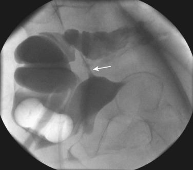 Figure 29-3, Barium enema with water-soluble contrast in a postoperative patient demonstrates a fistulous tract (arrow).