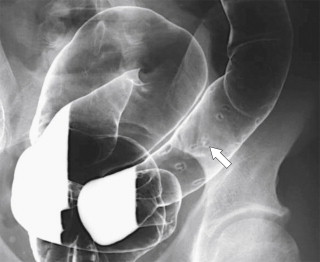Figure 5-11, DCBE in 38-year-old man with chronic ulcerative colitis and filiform polyp formation ( arrow ).