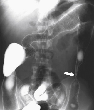 Figure 5-12, DCBE in a 41-year-old woman with chronic ulcerative colitis and diffuse colonic lead-piping. There is also a descending colon benign inflammatory stricture ( arrow ).