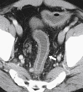 Figure 5-14, Axial contrast-enhanced CT in a 45-year-old man with sigmoid mural stratification ( arrow ) due to acute ulcerative colitis.