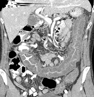 Figure 5-15, Coronal contrast-enhanced CT in a 61-year-old woman with marked colonic mucosal thickening due to acute ulcerative colitis.