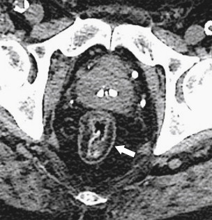 Figure 5-16, Axial contrast-enhanced CT in a 70-year-old man with a fat halo sign from chronic ulcerative colitis ( arrow ).