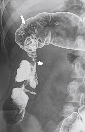Figure 5-17, BE in a 40-year-old woman with a chronic ascending colon stricture ( arrow ) and filiform pseudopolyps ( small arrow ) due to chronic ulcerative colitis.