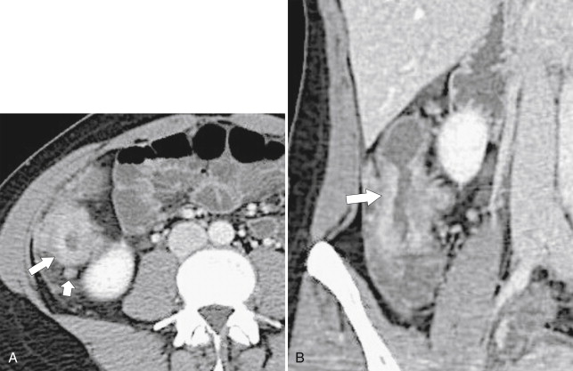 Figure 5-18, Axial ( A ) and coronal ( B ) contrast-enhanced CT in a 61-year-old woman with known ulcerative colitis and now an ascending colon adenocarcinoma ( arrows ) with associated lymphadenopathy ( small arrow ).