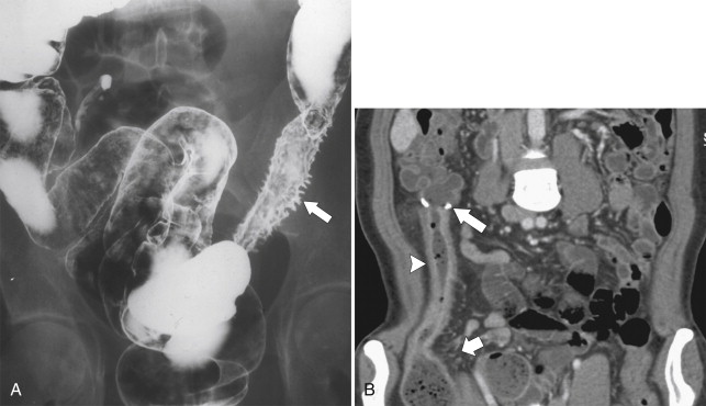 Figure 5-20, A, BE in a 33-year-old man with focal left-sided Crohn disease with spiculated mucosal changes from acute disease ( arrow ). B, Coronal contrast-enhanced CT in a 44-year-old woman with prior surgery for Crohn disease ( arrow ) and now acute disease in the ascending colon ( arrowhead ) with wall thickening and mucosal and mesenteric hyperemia ( small arrow ).