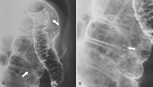 Figure 5-21, A, BE in a 36-year-old woman with numerous apthous ulcers ( arrows ) in the left colon from Crohn disease. B, Magnified view of apthous ulcers ( arrow ) in the distal transverse colon.