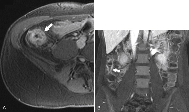 Figure 5-22, Axial fat-saturated postcontrast T1-weighted images in a 22-year-old woman with focal Crohn disease of the ascending colon ( A, arrows ). B, Coronal view demonstrates mucosal enhancement and mural thickening ( arrow ).