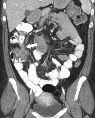 Figure 5-23, Coronal CT in a 38-year-old woman with a coloenteric fistula ( arrow ) due to Crohn disease.