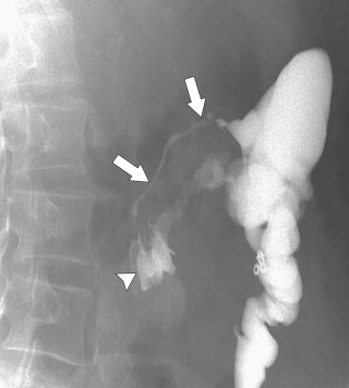 Figure 5-25, BE in a 44-year-old woman with a coloenteric fistula ( arrows ) with a segment of jejunum ( arrowhead ) due to Crohn disease.