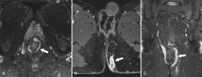 Figure 5-26, Axial ( A and B ) T2-weighted and coronal ( C ) T1-weighted fat-saturated postcontrast MRI in a 43-year-old man with a perianal fistula with an almost circumferential perianal fistula ( arrows ) tracking to the left medial buttock.