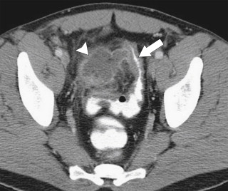 Figure 5-27, Axial contrast-enhanced CT in a 38-year-old man with sigmoid mural thickening ( arrow ) and a 4-cm pericolonic Crohn abscess ( arrowhead ).