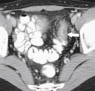 Figure 5-28, Axial contrast-enhanced CT in a 28-year-old woman with circumferential sigmoid thickening ( arrow ) due to adenocarcinoma as a complication of Crohn disease.