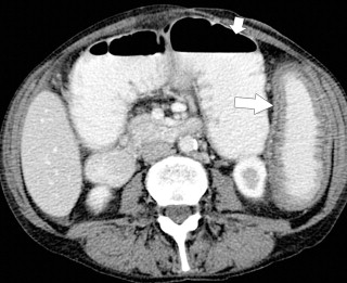 Figure 5-29, Axial contrast-enhanced CT in a 66-year-old woman with colonic dilatation ( short arrow ) and mural thickening of the descending colon ( arrow ) due to eosinophilic colitis.
