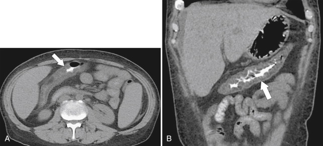 Figure 5-30, Axial ( A ) and coronal ( B ) noncontrast CT in a 44-year-old man with transverse colonic thickening ( arrows ) due to graft-versus-host disease.