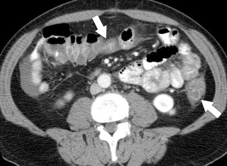 Figure 5-31, Axial contrast-enhanced CT in a 58-year-old man with recent right colectomy for colon adenocarcinoma and now with a chemotherapy-induced pancolitis ( arrows ).
