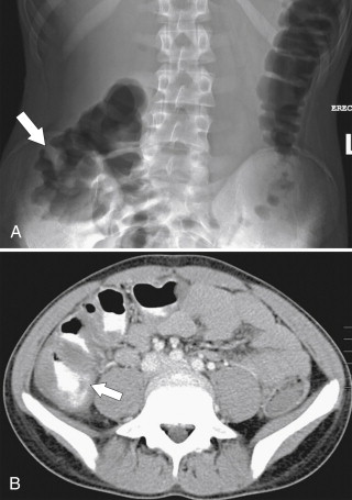 Figure 5-33, Plain abdominal radiograph ( A ) and axial contrast-enhanced CT ( B ) in a 17-year-old male adolescent undergoing chemotherapy with cecal mural thickening ( arrows ) due to typhlitis.