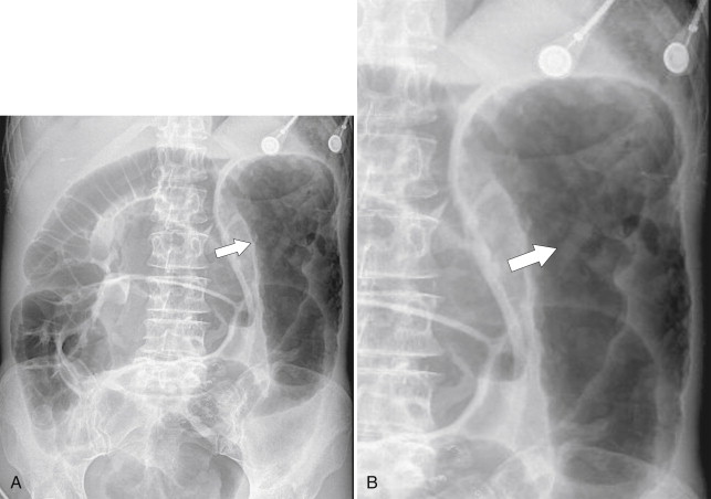 Figure 5-35, A and B, Plain abdominal radiograph ( A ) and magnified view ( B ) in a 56-year-old man with a left-sided toxic megacolon due to ischemic colitis. There is thumb-printing of the colonic mucosa at the splenic flexure ( arrows ).