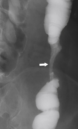 Figure 5-36, BE in a 71-year-old man with a left mid-descending colon stricture ( arrow ) secondary to fibrosis from prior ischemic colitis.