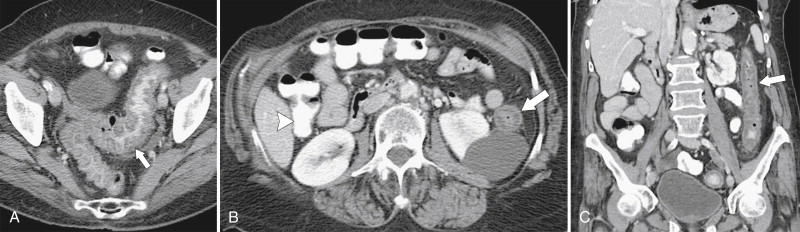 Figure 5-37, Axial ( A and B ) and coronal ( C ) contrast-enhanced CT in a 66-year-old woman with diffuse left colonic mucosal thickening ( arrows ) due to ischemic colitis. Note the normal right colon ( arrowhead ).