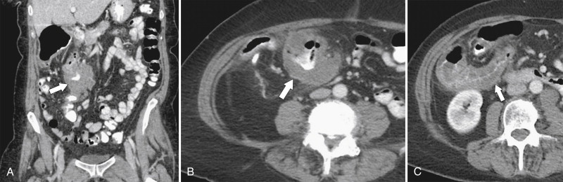 Figure 5-38, A through C, Coronal and axial contrast-enhanced CT in a 62-year-old man with a transverse colon adenocarcinoma ( arrows ) with proximal ascending colon mucosal thickening due to secondary ischemia.