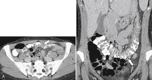 Figure 5-39, Axial ( A ) and coronal ( B ) contrast-enhanced fat-saturated CT in a 37-year-old female marathon runner with transverse colon mucosal thickening ( arrows ) due to “runner’s” colitis.