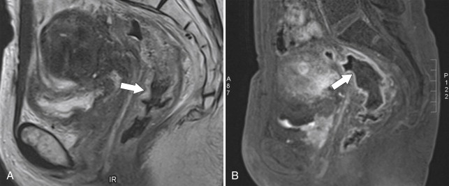 Figure 5-40, Sagittal T2-weighted ( A ) and contrast-enhanced MRI ( B ) in a 47-year-old woman with rectal wall thickening ( arrow ) and mucosal hyper-enhancement due to radiation colitis ( arrows ).