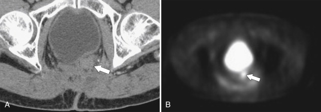Figure 5-41, Axial CT ( A ) and PET ( B ) in a 73-year-old man with prior colectomy for rectal cancer and question of postoperative pelvic changes versus recurrence. PET imaging confirms tumor recurrence ( arrows ).