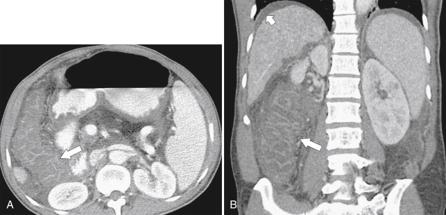 Figure 5-42, Axial ( A ) and coronal ( B ) contrast-enhanced CT in a 44-year-old man with cirrhosis and portal colopathy ( arrows ). There is associated ascites and splenomegaly ( small arrow ).