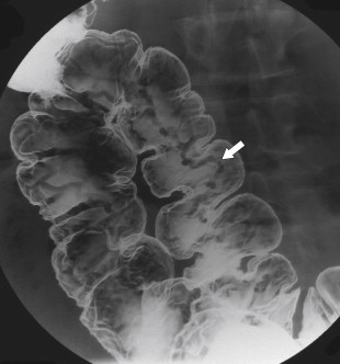 Figure 5-43, DCBE in a 56-year-old woman with colonic varices ( arrow ).