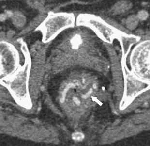 Figure 5-44, Axial contrast-enhanced CT in a 64-year-old man with rectal varices ( arrow ).